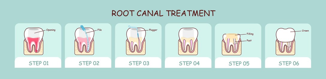 what happens during a root canal